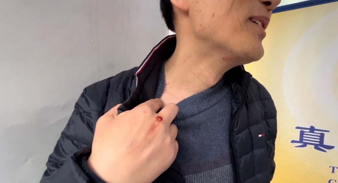 Falun Gong practitioner David Fang displays injuries from the assault in New York on Feb. 16, 2023. (Linda Lin/The Epoch Times)