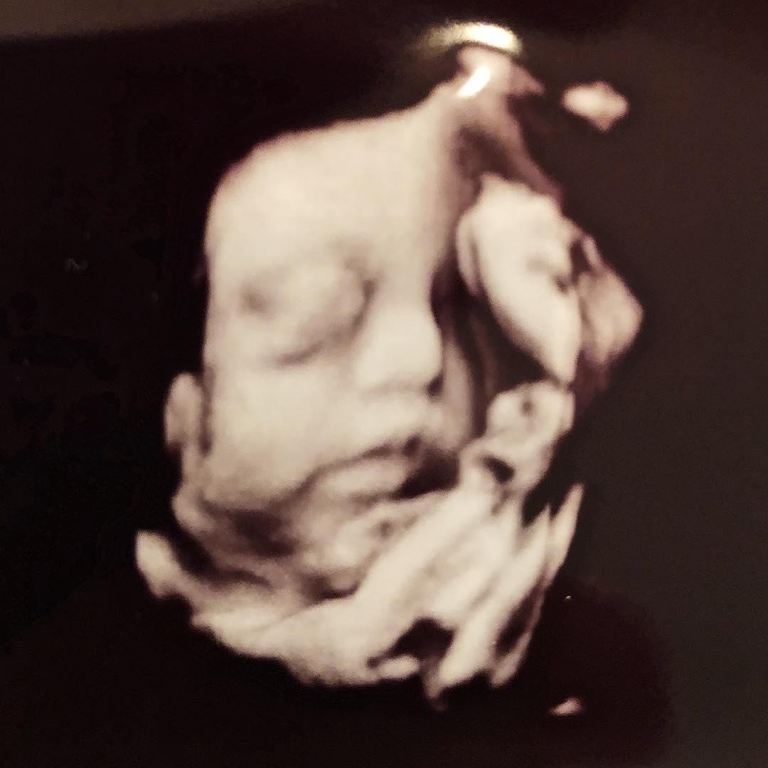 An ultrasound image of baby Aria in the womb. (Courtesy of <a href="https://www.instagram.com/kirstinczernek/">Kirstin Czernek</a>)