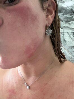 Katie Schwarzwaelder says she develops this rash when she returns to her Darlington Township, Pennsylvania, home and business, just a half-mile from the Norfolk Southern train derailment. (Courtesy of Katie Schwarzwaelder)
