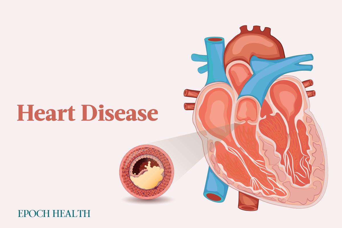 The Essential Guide to Heart Disease: Symptoms, Causes, Treatments, and Other Remedies