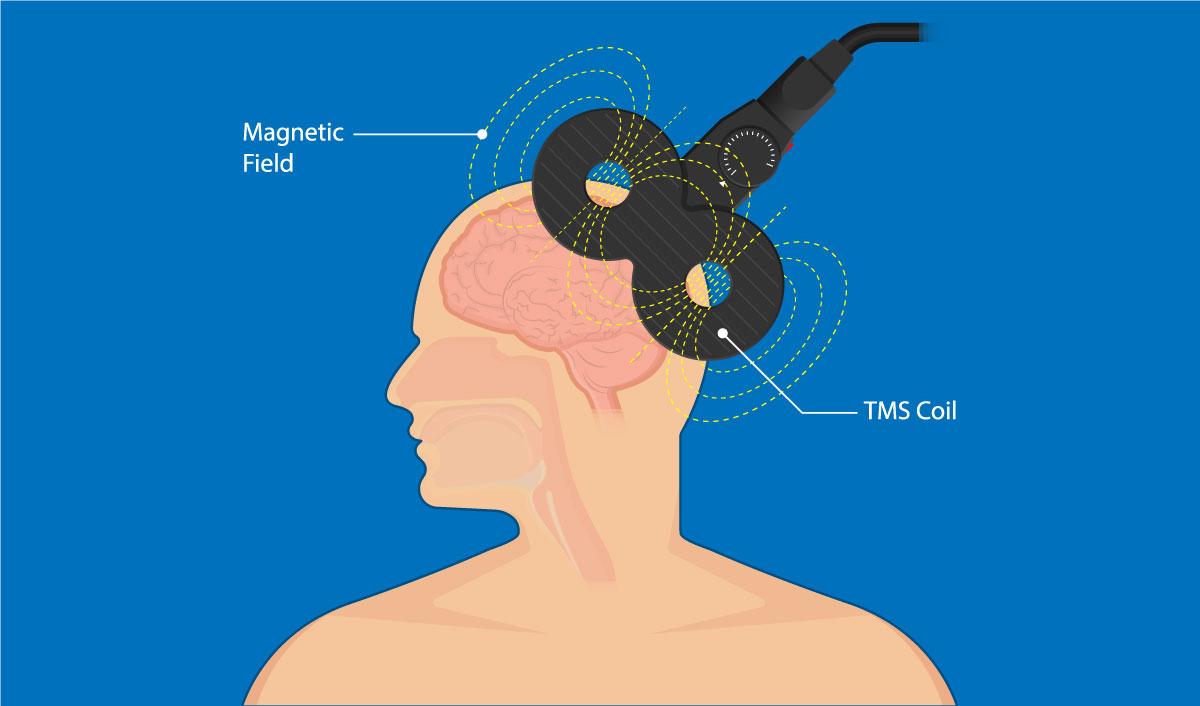 Transcranial magnetic stimulation (TMS) treatment. (Pepermpron/Shutterstock)