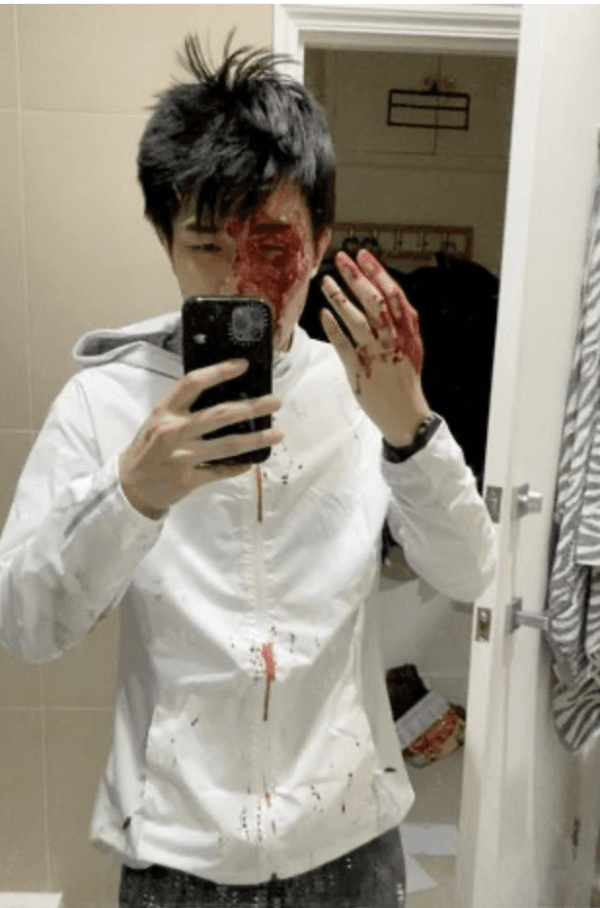 An undated photo showing the injuries sustained by Hong Kong activist Finn Lau who was attacked in London in late 2020. (Courtesy of Finn Lau)
