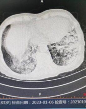CT image of the 83-year-old patient taken on Jan. 6, 2023. (Courtesy of the patient's family)