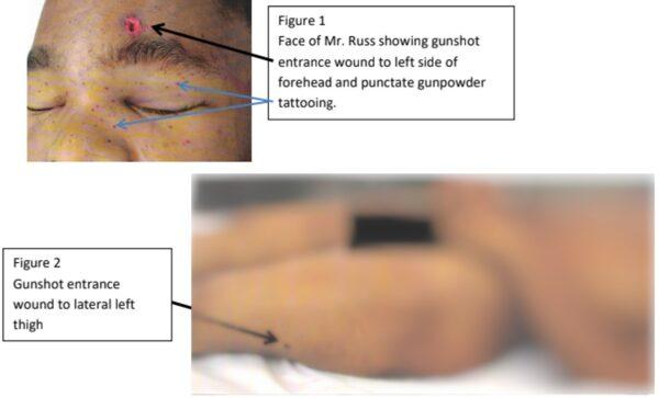 Screenshot of autopsy photos for DeAndre Russ. The skin on the left side of Russ's face was marked with "stippling." (Exhibit A: Defendant's January 2019 motion for a new trial)