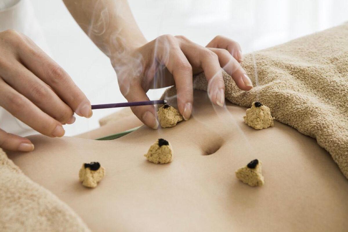 <span style="font-weight: 400;">Moxibustion at work. </span>(Shutterstock)