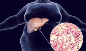 FDA Approves First Treatment for Fatty Liver Scarring Disease