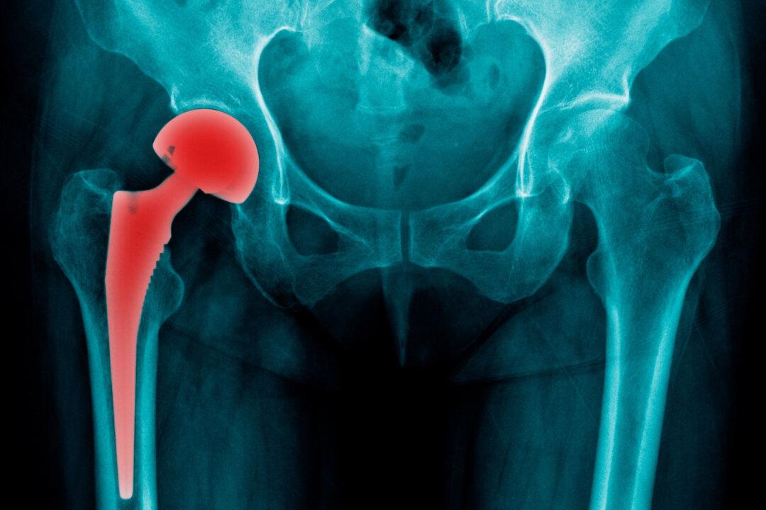 Alzheimer’s-Like Symptoms After Hip Replacement May Be From Cobalt Poisoning