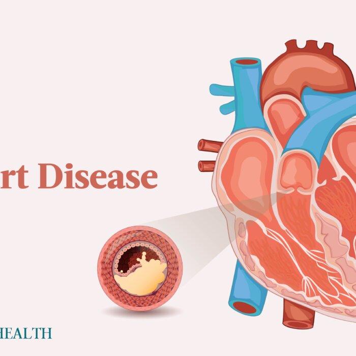 The Essential Guide to Heart Disease: Symptoms, Causes, Treatments, and Other Remedies