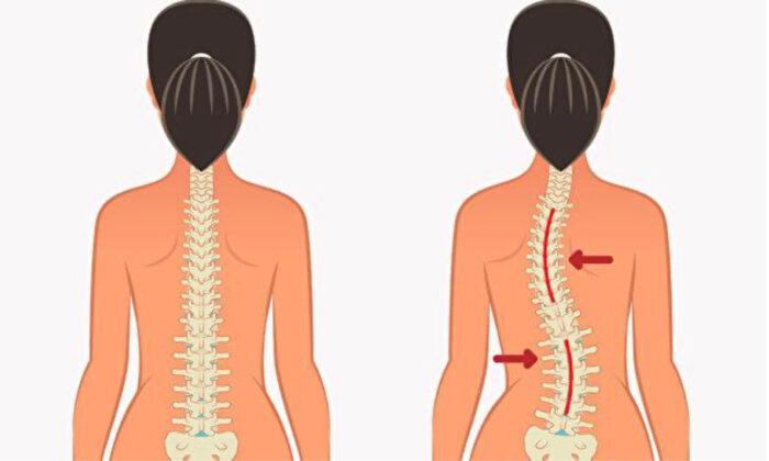 3 Simple Moves to Improve Spinal Health and Correct Scoliosis