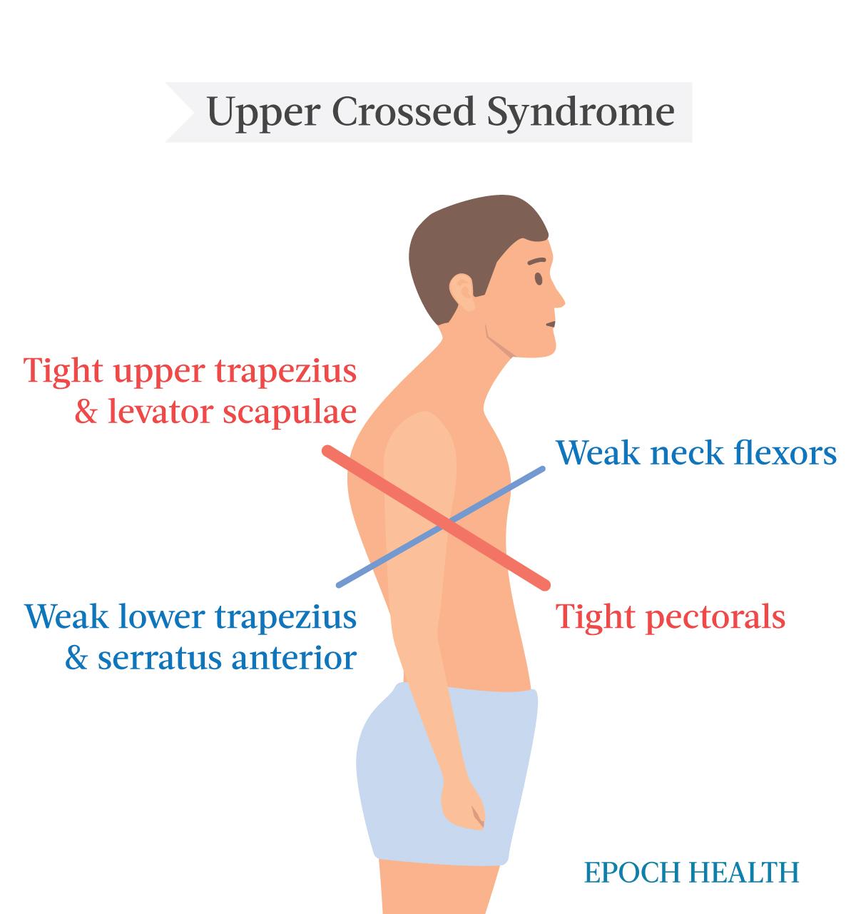 Upper crossed syndrome. (The Epoch Times)