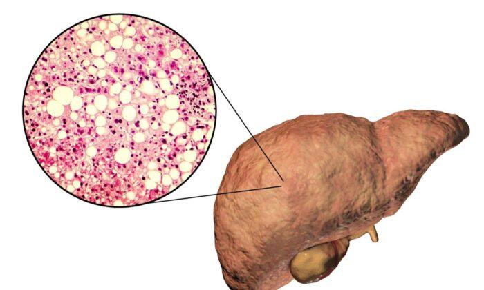 Fatty Liver Increases Risk of Liver Cancer–Tips for Early Detection and Prevention