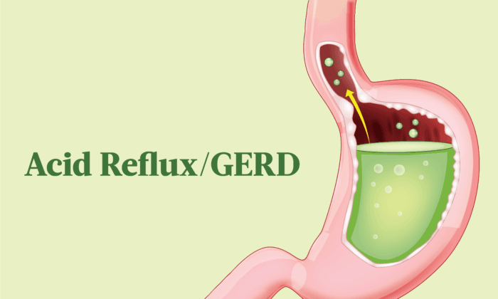 Acid Reflux and GERD: Symptoms, Causes, Treatments, and Natural Remedies