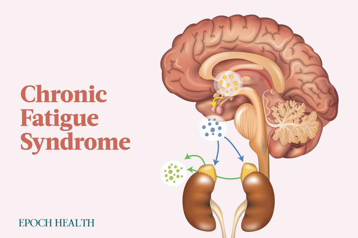 The Essential Guide to Chronic Fatigue Syndrome: Symptoms, Causes, Treatments, and Natural Remedies