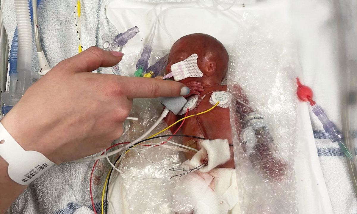 Baby Born Weighing Less Than a Loaf of Bread and Given Only 10 Percent Survival Chance, Celebrates First Birthday