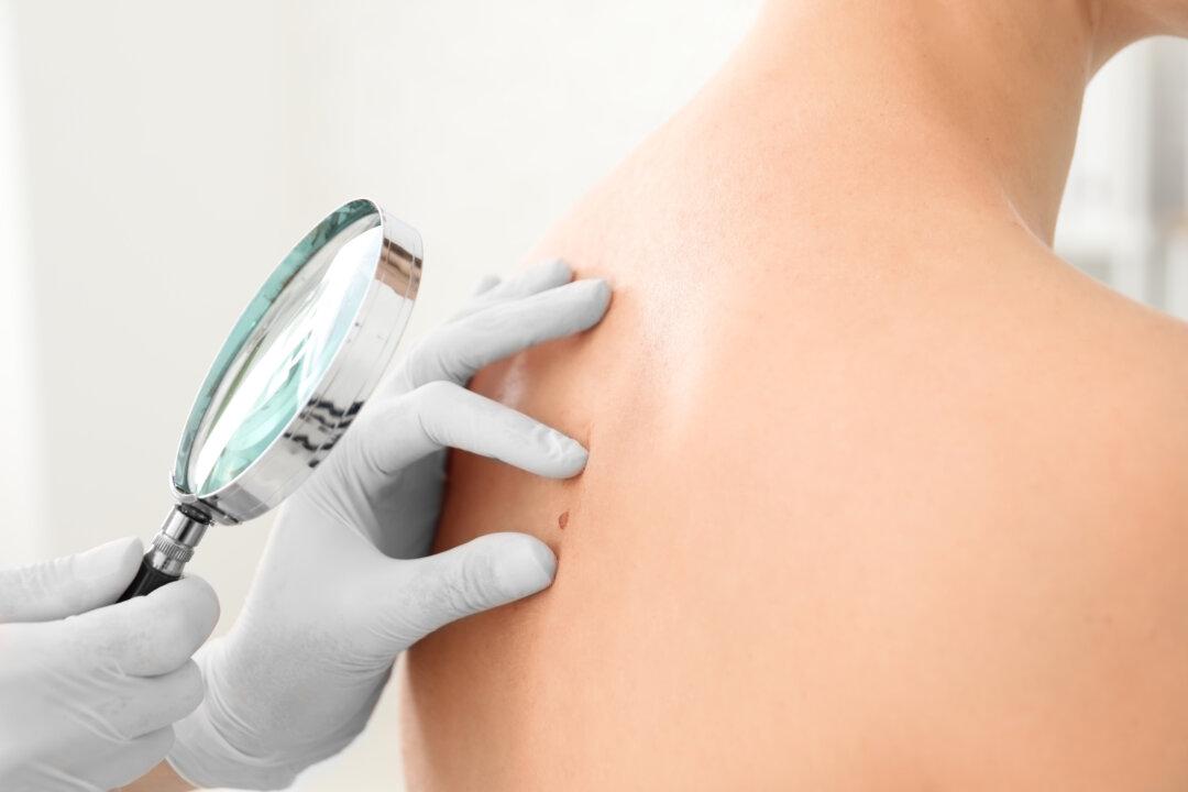 Skin Cancer: How to Self-Detect and 5 Tips to Prevent