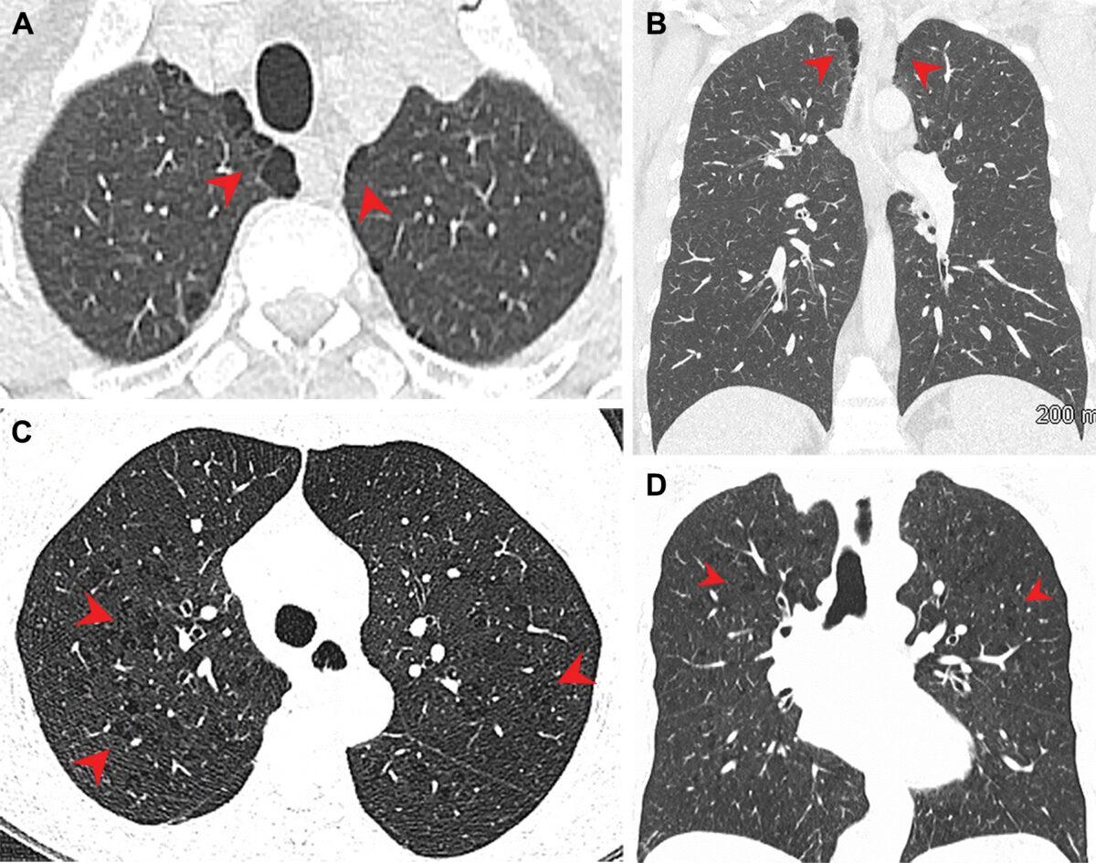 Pulmonary emphysema in (A, B) marijuana and (C, D) tobacco smokers. (A) Axial and (B) coronal CT images in a 44-year-old male marijuana smoker show paraseptal emphysema (arrowheads) in bilateral upper lobes. (C) Axial and (D) coronal CT images in a 66-year-old female tobacco smoker with centrilobular emphysema represented by areas of centrilobular lucency (arrowheads). (Courtesy of the Radiological Society of North America)