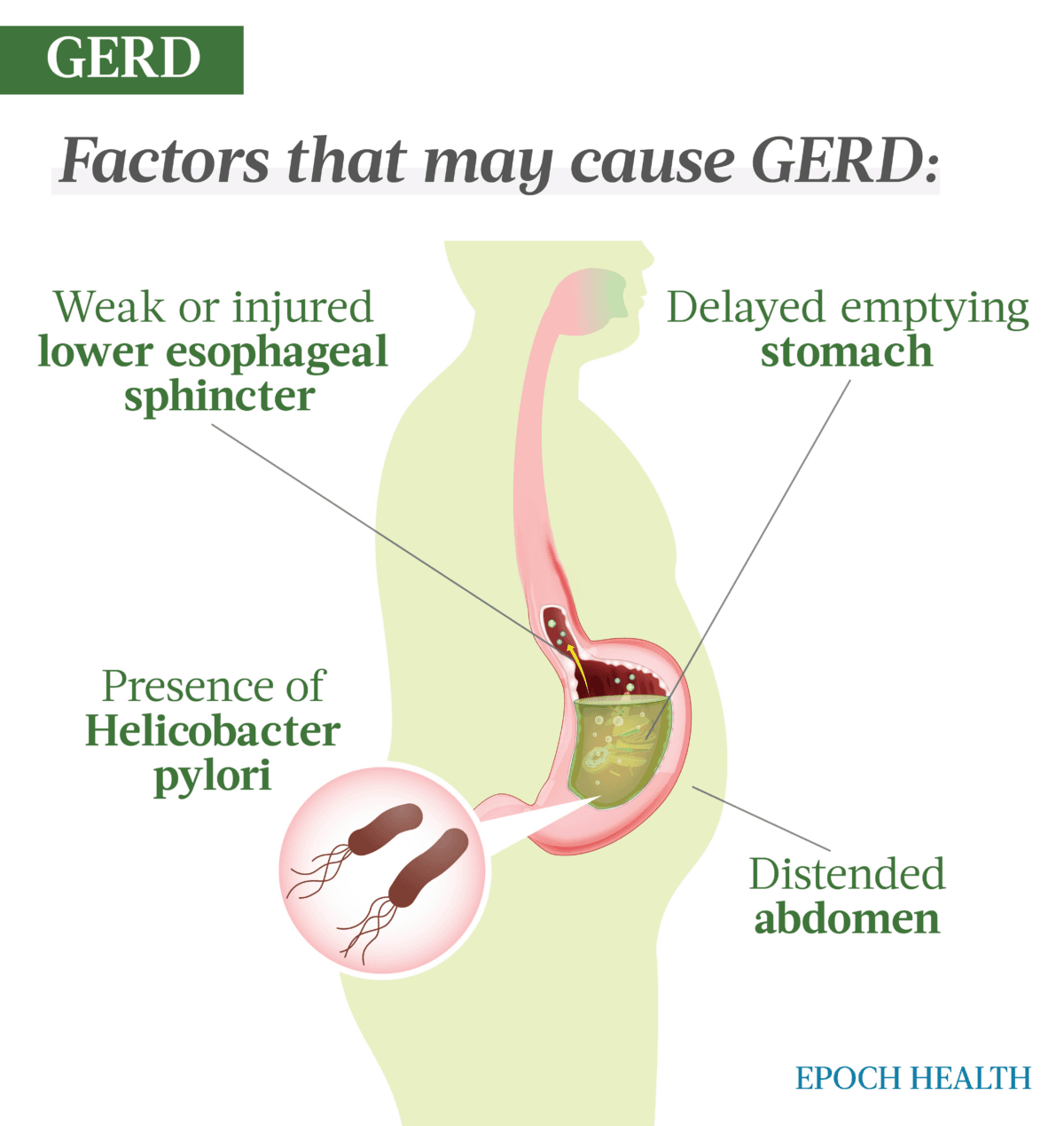 A single cause of GERD hasn't been determined, but several physical factors are typically at play. (The Epoch Times)