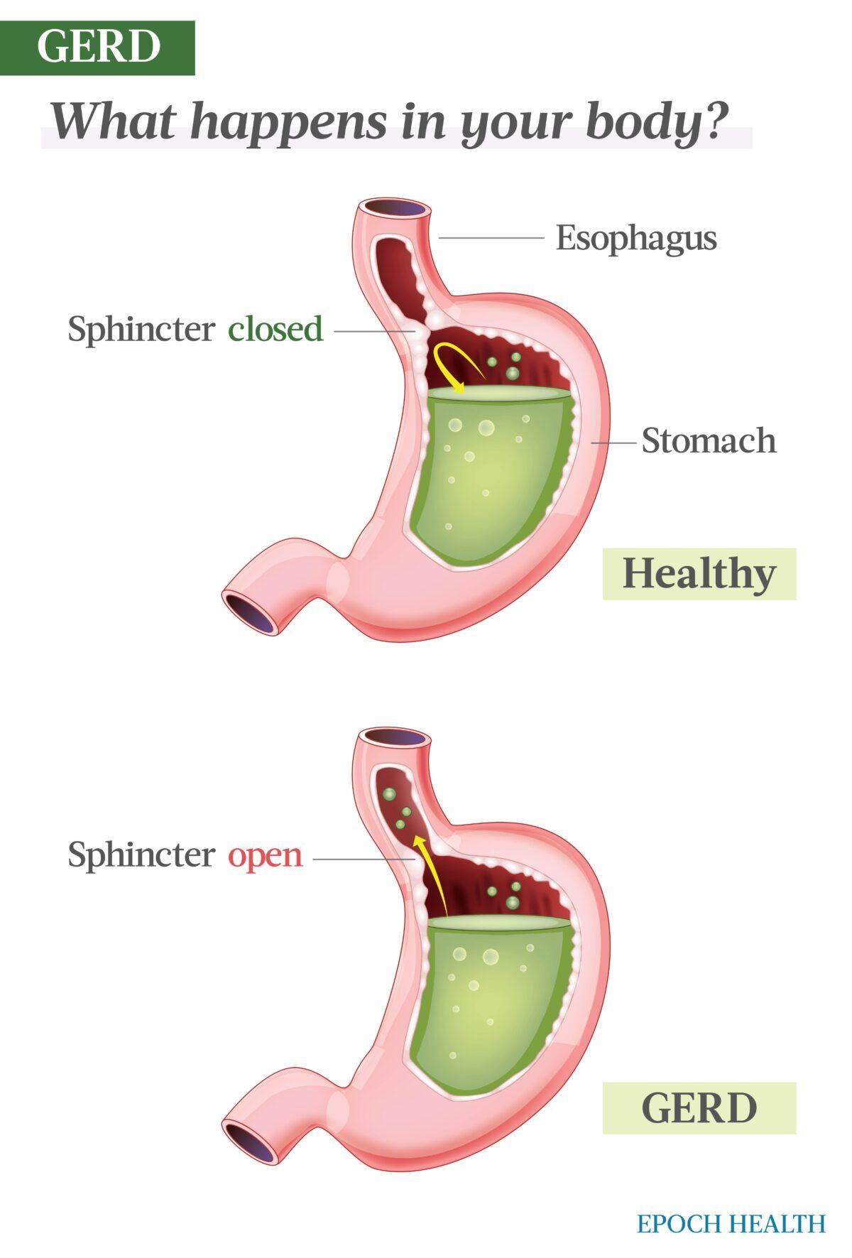 In GERD, the esophageal sphincter doesn't close properly, allowing stomach acid to creep into the esophagus. (The Epoch Times)