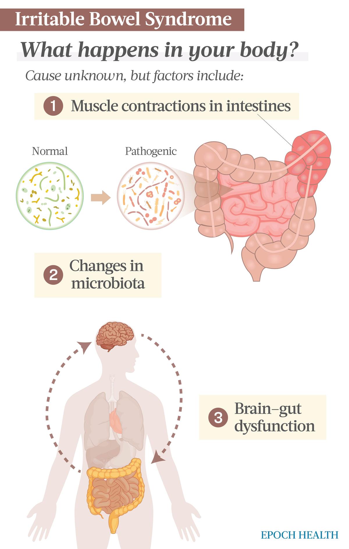 There isn't one known cause for IBS, but factors like early life stress or illness can lead to changes in microbiota, brain–gut dysfunction, and muscle contractions in the intestines that result in IBS. (The Epoch Times)
