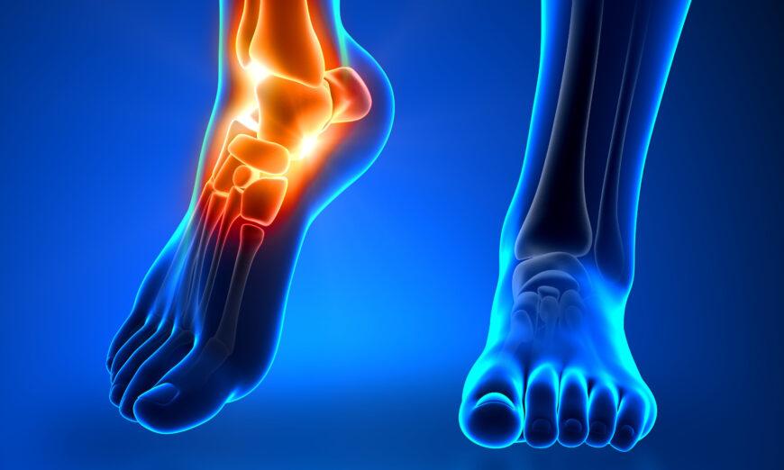 Chronic Ankle Pain: Often Caused by Weak Ankles, 5 Exercises to Strengthen and Prevent Injury
