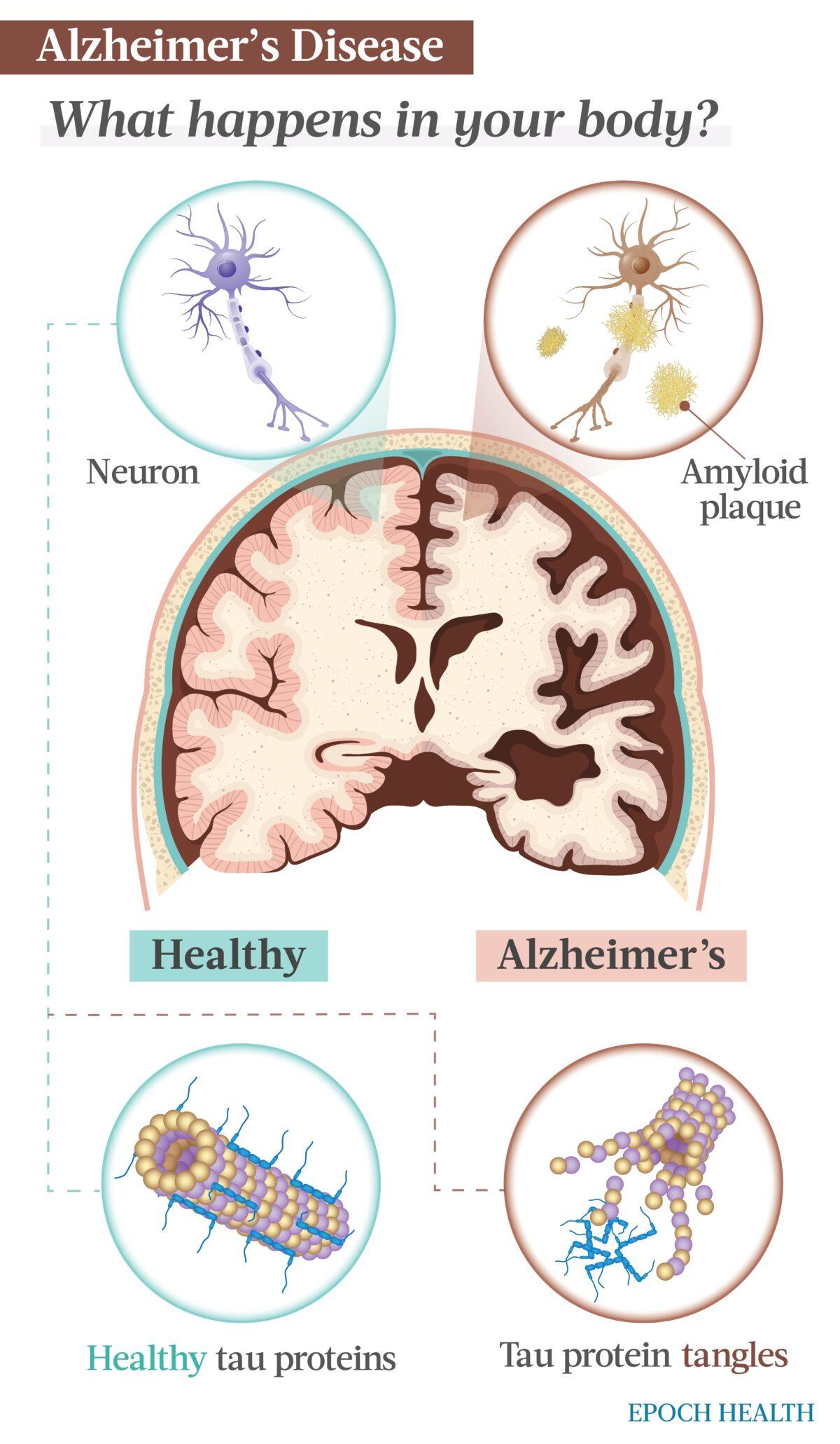 Two proteins, beta-amyloid and tau, are implicated in Alzheimer's disease. (The Epoch Times)