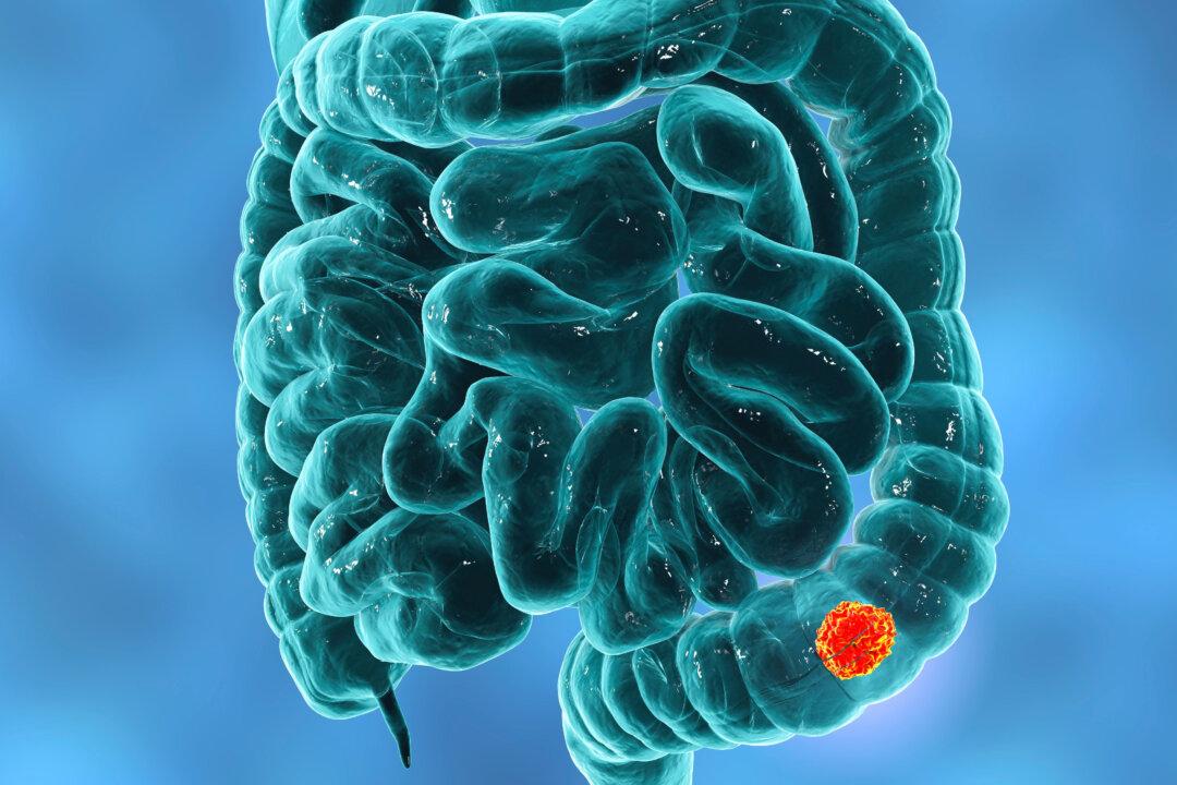 Know the Difference Between Hemorrhoids and Colorectal Cancer and When to Seek Help, Doctor Explains