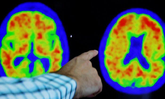 Japan's Otsuka Pharma Gets FDA Approval for Alzheimer's Agitation Drug