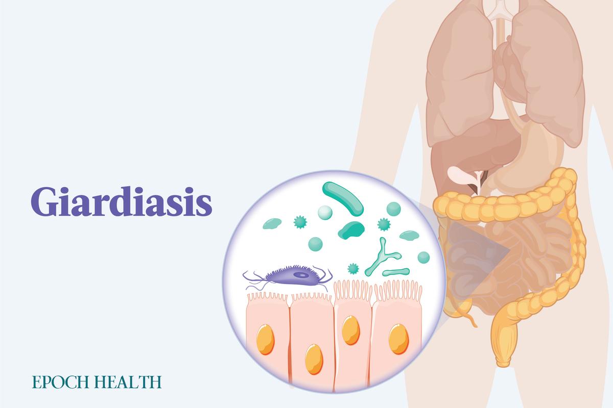 The Essential Guide to Giardiasis: Symptoms, Causes, Treatments, and Natural Approaches