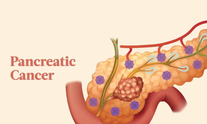 The Essential Guide to Pancreatic Cancer: Symptoms, Causes, Treatments, and Natural Approaches