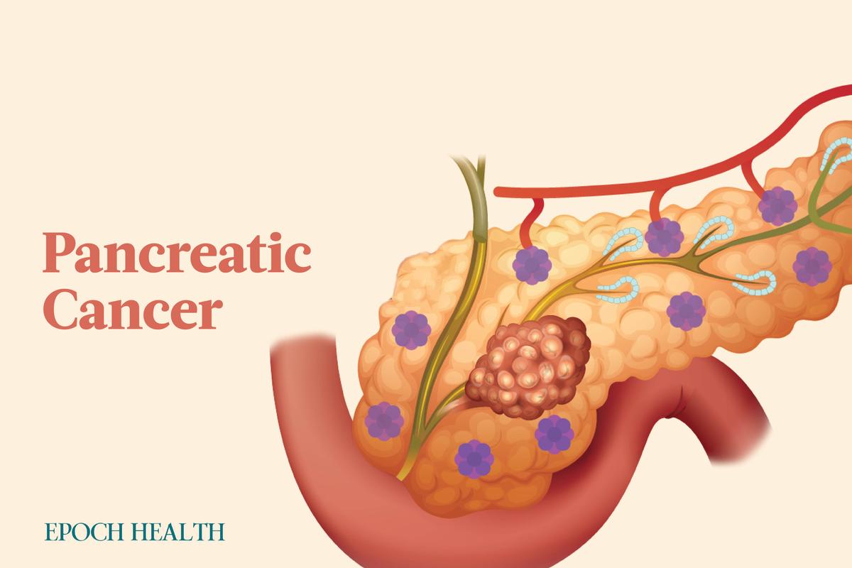The Essential Guide to Pancreatic Cancer: Symptoms, Causes, Treatments, and Natural Approaches