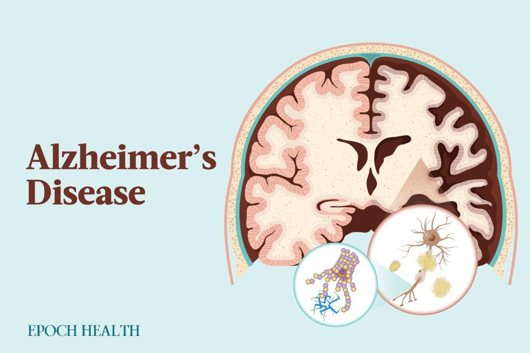 The Essential Guide to Alzheimer’s Disease: Symptoms, Causes, Treatments, and Natural Remedies