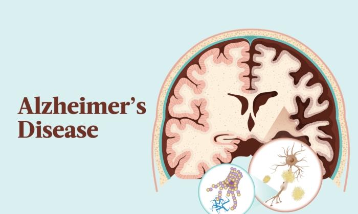 The Essential Guide to Alzheimer's Disease: Symptoms, Causes, Treatments, and Natural Remedies