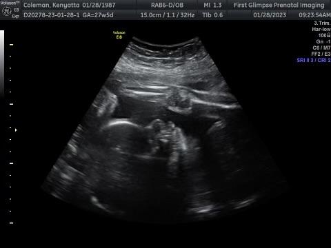 Ultrasound at 27 weeks and 6 days. (Courtesy of the Coleman family)