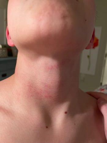 A Fairfax County Public Schools seventh grader had red marks on his neck after being choked by a female student on the bus in Fairfax County, Va., on Jan. 23, 2023. (Courtesy of Taylor Brock)