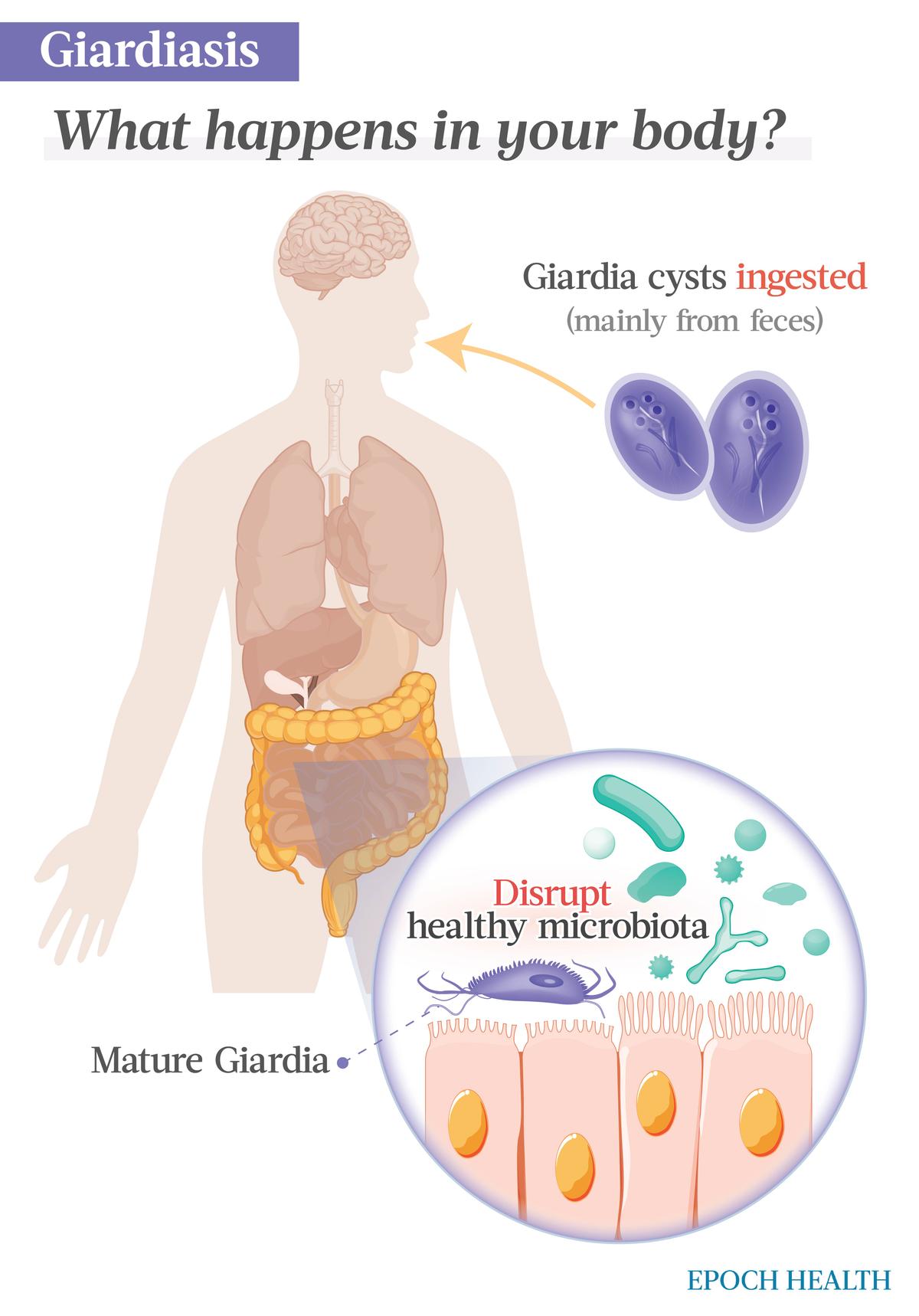 Once ingested via feces, Giardia cysts mature and infect the small intestines, where the parasites disrupt the healthy microbiota. (The Epoch Times)