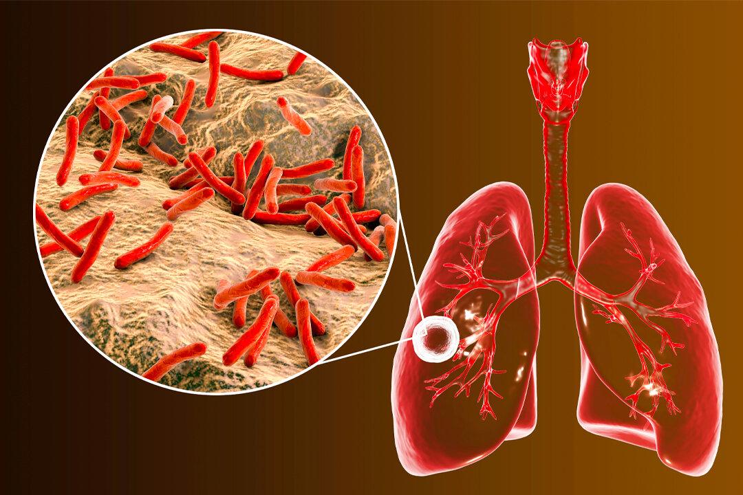 Tuberculosis on the Rise: Here’s What to Know About the Disease