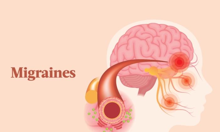 The Essential Guide to Migraines: Symptoms, Causes, Treatments, and Natural Approaches