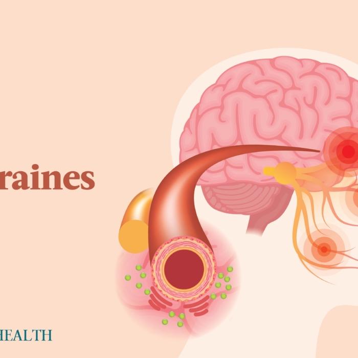 The Essential Guide to Migraines: Symptoms, Causes, Treatments, and Natural Approaches