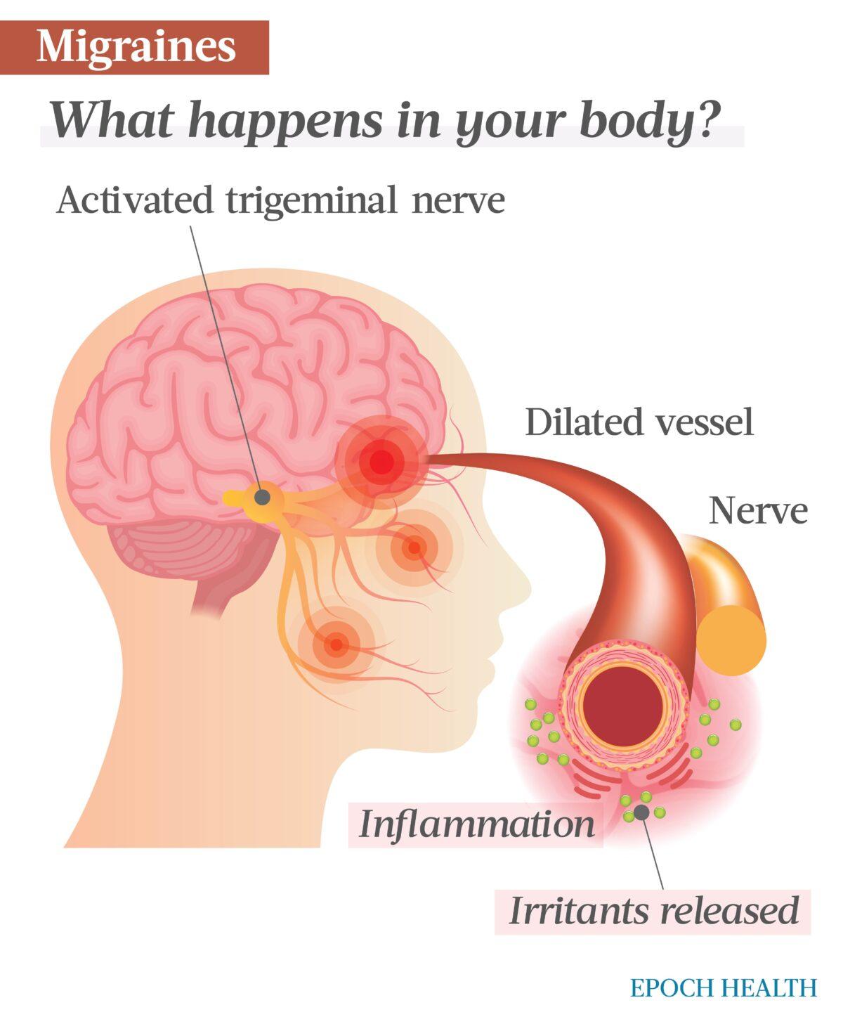Migraines are widely thought to develop due to activated trigeminal nerves, a pain pathway connecting your face, teeth, sinuses, and blood vessels on the brain's surface. These vessels dilate, and the brain releases chemicals that cause inflammation. Increased blood flow to the brain and vessel contractions manifest as throbbing. (The Epoch Times)