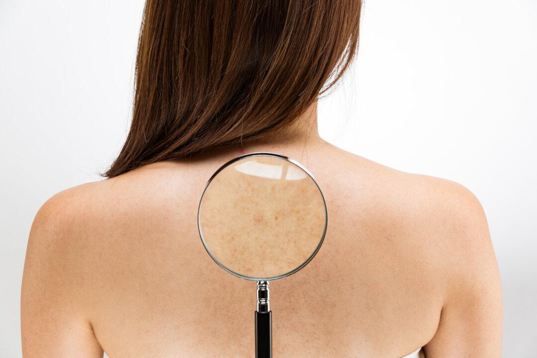 Spotting Trouble: A Guide to Identifying Melanoma Skin Cancer