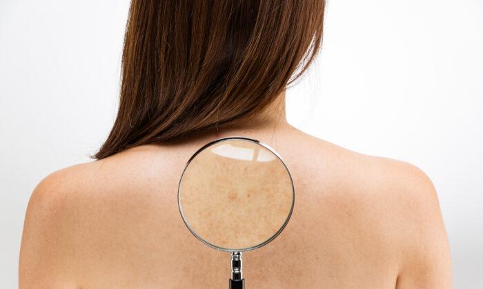 Spotting Trouble: A Guide to Identifying Melanoma Skin Cancer