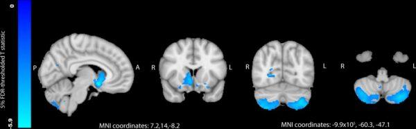 Differences in gray matter between gout patients and controls. (<a href="https://www.nature.com/articles/s41467-023-38602-6">Nature Communications</a>, <a href="https://creativecommons.org/licenses/by/4.0/">Creative Commons 4.0</a>, DOI: 10.1038/s41467-023-38602-6)
