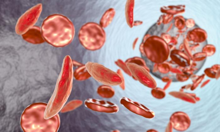 Global Sickle Cell Deaths Eleven Times Higher Than Recorded Reveals Lancet Study