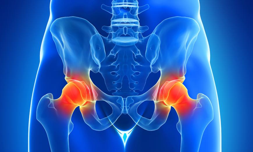 Chronic Hip Pain: Common Causes, 5 Exercises to Relieve