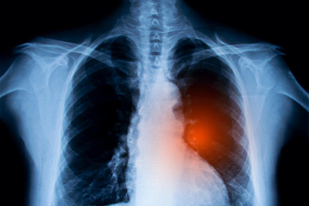 Daily Pill May Cut Lung Cancer Mortality in Half: Study