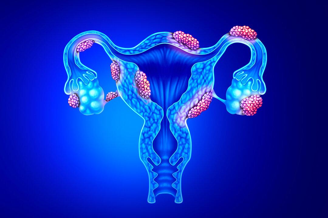 A Surprising Cause of Endometriosis