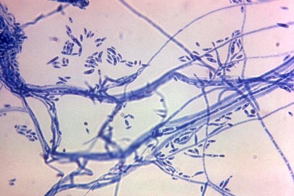 This microscope photo provided by the Centers for Disease Control and Prevention shows a Fusarium sp. fungal organism in 1972. The fungus is linked to a rare yet deadly form of meningitis. (Dr. Lucille K. Georg/CDC via AP)