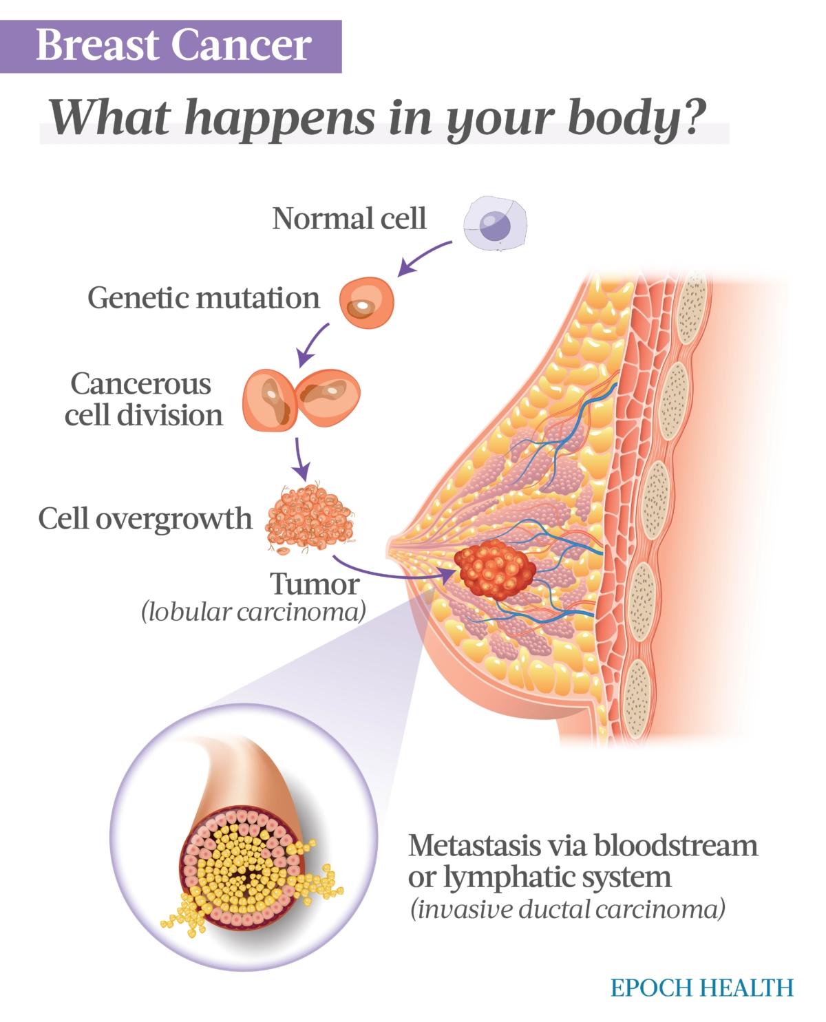A genetic mutation prompts cancerous cell growth, eventually leading to a tumor. Metastasis occurs if the cancerous cells break through the duct or lobe that contains them. (The Epoch Times)