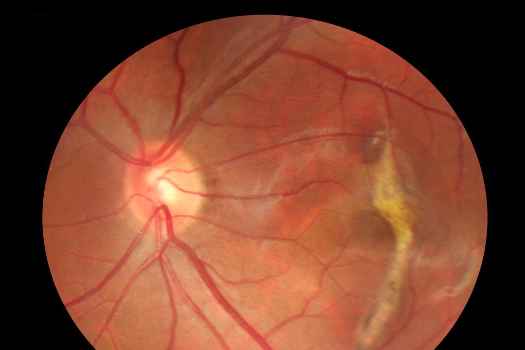 5 Patients Left Blind After Taking Newly Approved Drug Treating Vision Loss