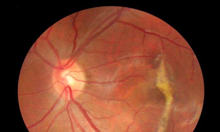 5 Patients Left Blind After Taking Newly Approved Drug Treating Vision Loss